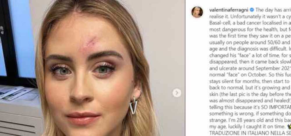 Valentina Ferragni tumore maligno della pelle