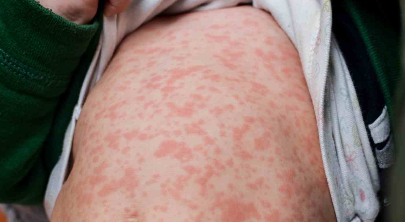 Esplosione di morbillo in Europa: l'OMS rivela un incremento dei casi di 30 volte - A cosa fare attenzione