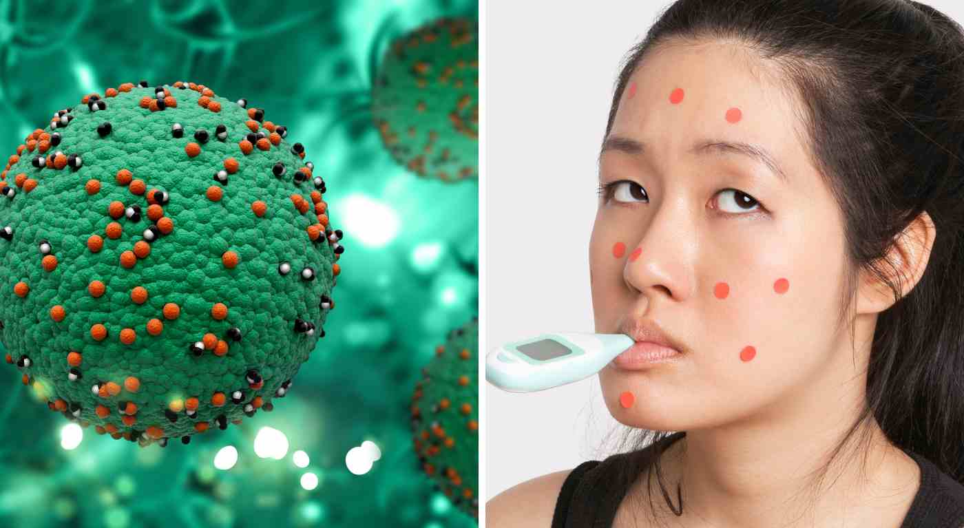 Esplosione di morbillo in Europa: l'OMS rivela un incremento dei casi di 30 volte - A cosa fare attenzione