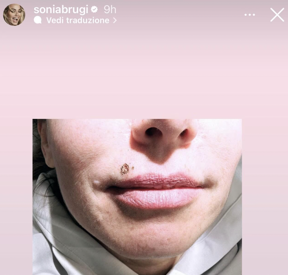 Sonia Bruganelli toglie il porro sulla bocca: il commento di Ferruzzi non si trattiene e fa il giro del web - FOTO