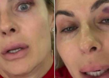 Martina Colombari e il livido sul volto: il video che ha allarmato i fan